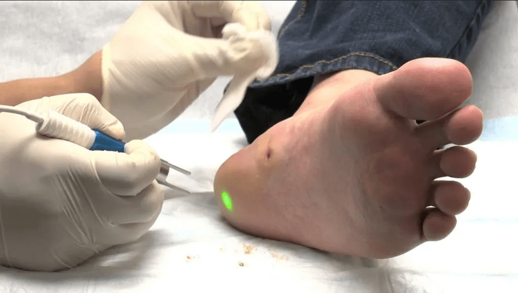 Treatment of plantar wart