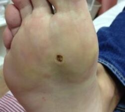 Ways to remove wart on the sole of the legs
