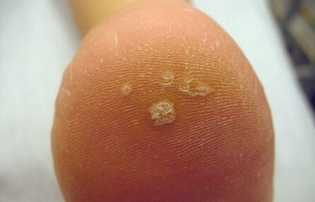 how to recognize a pierce wart