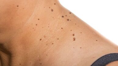How to get rid of papilloma around the neck