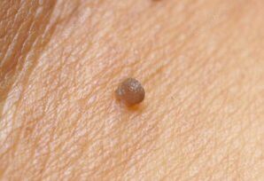 Clinical picture of papilloma
