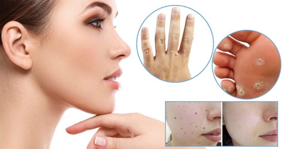 Papillomas removal methods
