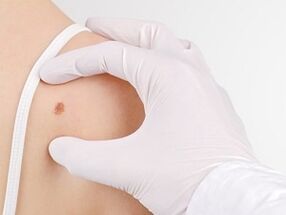 What is the danger of having papillomas on the body