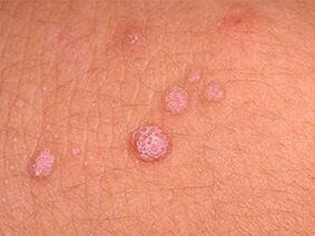 how to get rid of papillomas on the body