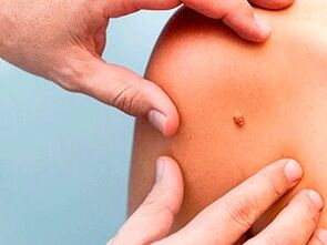 reasons for the appearance of papillomas on the body