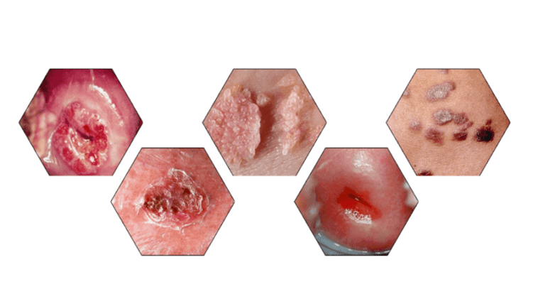 Why are papillomas dangerous