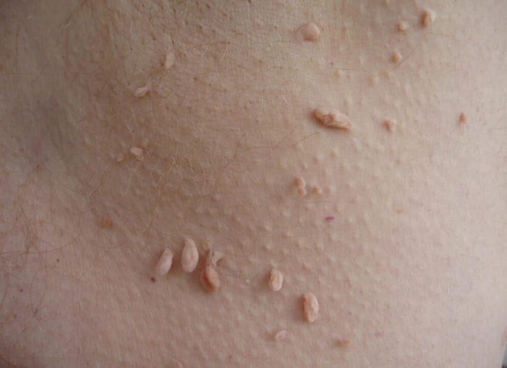 reasons for the appearance of warts on the human body