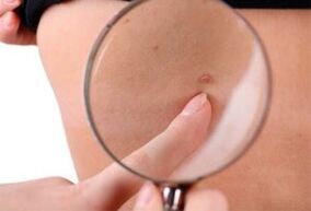 main causes of papillomas