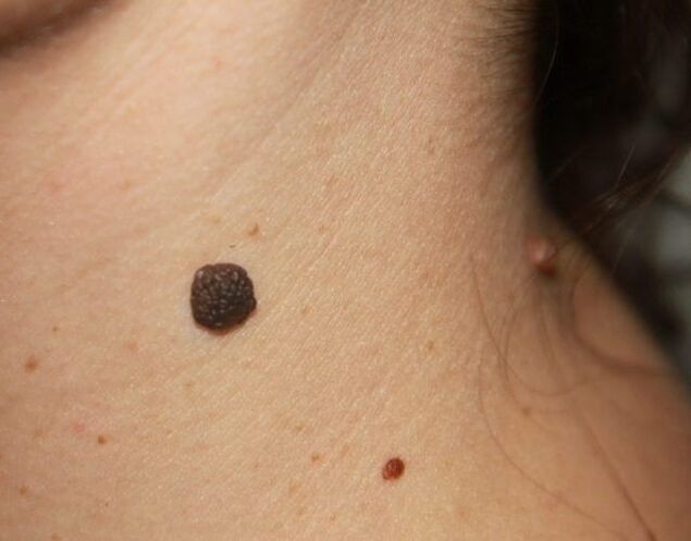 Flat papillomas on the neck