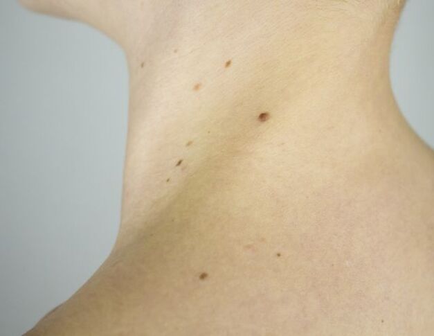 Papillomas on a girl's neck