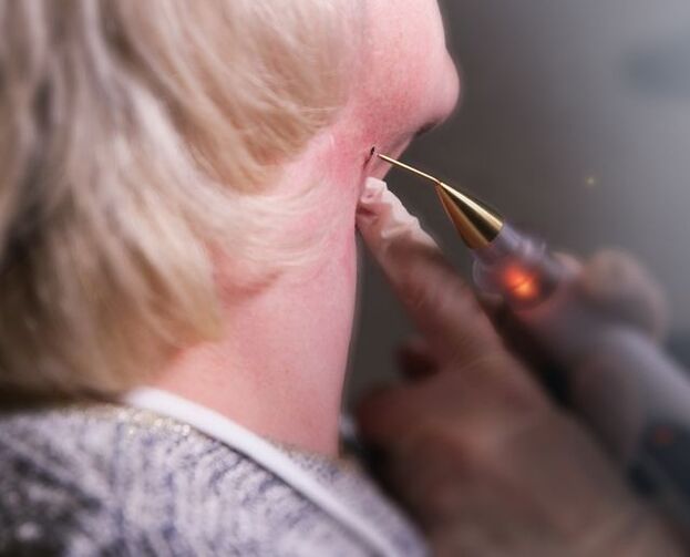 The process of removing papilloma on a woman’s neck