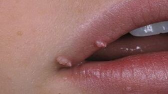 Papillomas on the lips