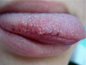 Papillomas on the tongue
