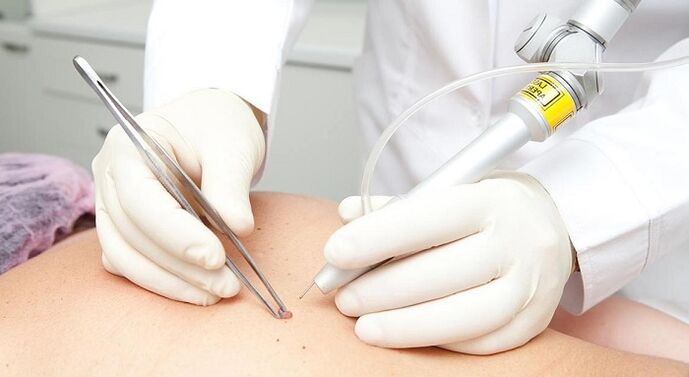 laser removal of papilloma for papillomavirus