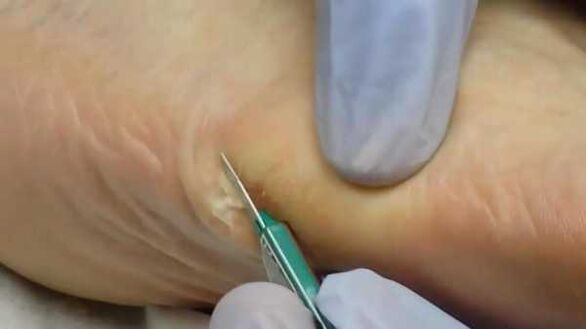Surgical removal of a plantar wart