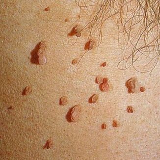 Papillomas often grow in colonies and can appear on the skin of the entire body
